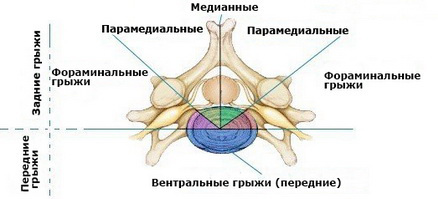 Лечение парамедианной грыжи межпозвоночного диска при помощи УВТ